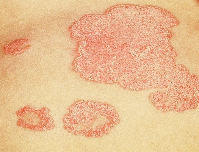 pictures of skin diseases #10