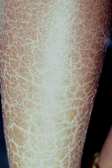 The scaling in ichthyosis is often most prominent over the lower legs.