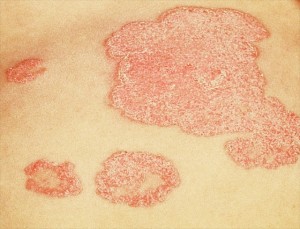 Image of psoriasis | Mary L. Williams, M.D., Elias and Williams, professors of dermatology and skin scientists