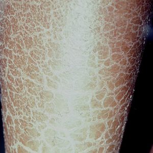Closed up of lower leg with ichthyosis. Scaling is often most prominent on the lower legs in individuals with ichthyosis.